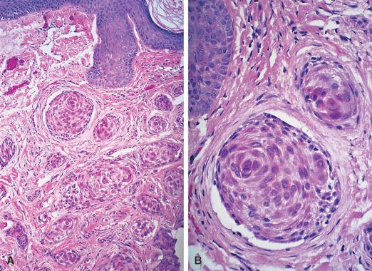 Figure 3.29, A and B, Microcystic adnexal carcinoma composed of nests of keratinocytes in a whorling pattern. This tumor was located in skin of upper lip in a 28-year-old woman.