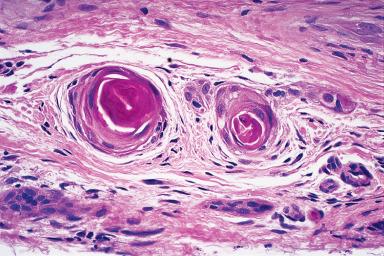 Figure 3.30, Microcystic adnexal carcinoma.