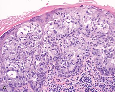 Figure 3.31, Extramammary Paget Disease of the Skin.