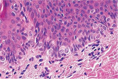 Figure 3.32, Clear Cell Papulosis of Skin.