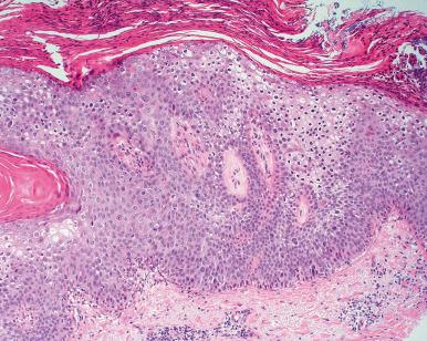 Figure 3.4, Microscopic Appearance of Bowen Disease.