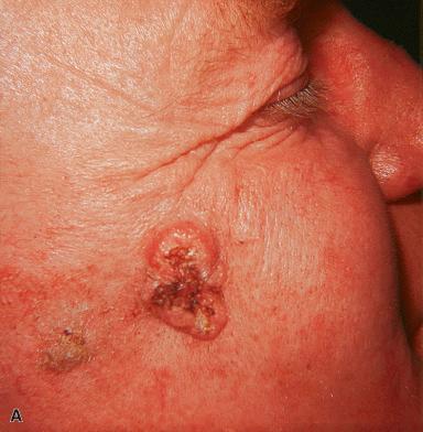 Figure 3.5, Squamous Cell Carcinoma.