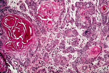 Figure 3.6, Deeply invasive, well-differentiated squamous cell carcinoma.