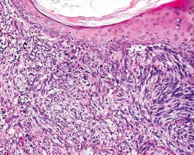 Figure 3.7, Squamous cell carcinoma with spindle metaplastic features.