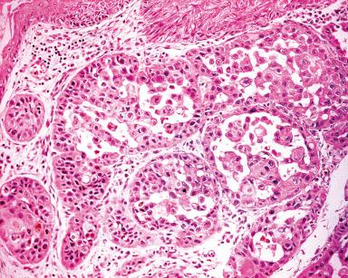 Figure 3.8, Adenoid (acantholytic) squamous cell carcinoma, resulting in a pseudoglandular appearance.