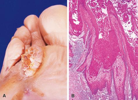 Figure 3.9, Verrucous Carcinoma of Skin.