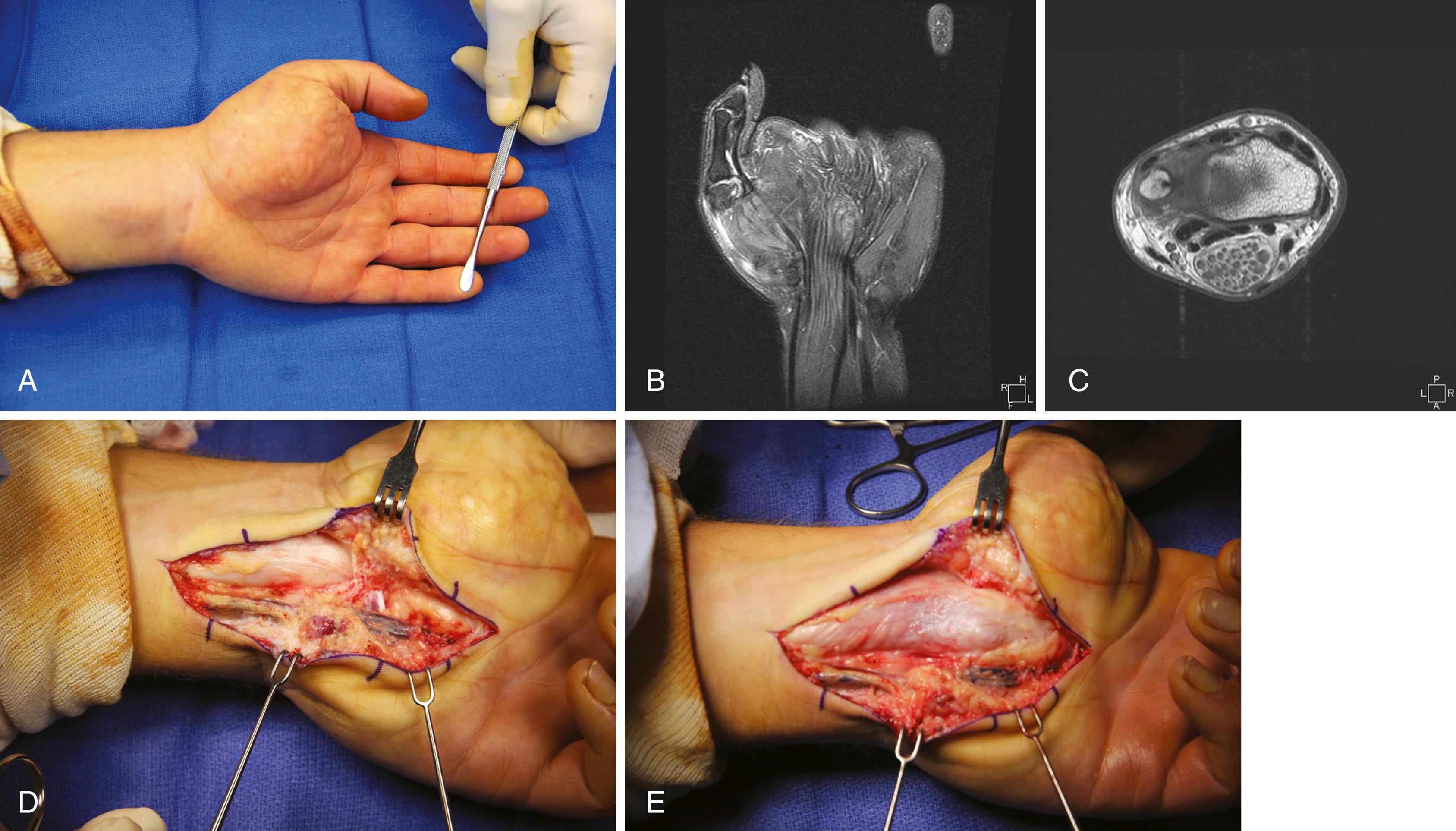 FIGURE 78.3, Lipofibroma hamartoma. A, A 21-year-old man with progressive neurologic symptoms with palmar and thumb hypertrophy since 5 years of age. B and C, MRI with classic findings of median nerve lipofibromatous hamartoma. D and E, Median nerve before and after division of transverse carpal ligament.