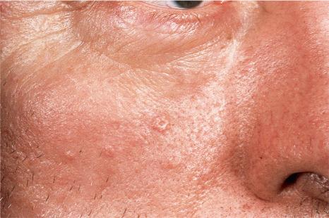 Fig. 32.1, Sebaceous hyperplasia: multiple lesions are present on the cheek. Note the central umbilication.