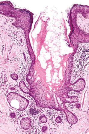 Fig. 32.11, Nevus sebaceous: in this field, the sebaceous gland communicates directly with the epidermis.