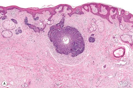 Fig. 32.13, Nevus sebaceous: ( A ) multinodular trichoblastoma; ( B ) the tumor cells have very regular, small, round-to-oval nuclei. Note the absence of mitoses or apoptosis.