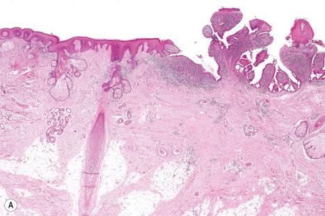 Fig. 32.14, ( A , B ) Nevus sebaceous: this example shows a syringocystadenoma papilliferum. Note the villous processes covered by a double layer of epithelium.