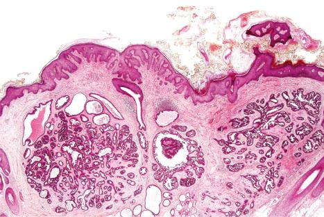 Fig. 32.15, Nevus sebaceous: this apocrine papillary adenoma arose in a background of nevus sebaceous.