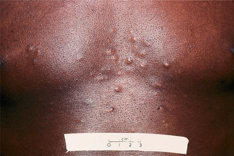 Fig. 32.17, Steatocystoma multiplex: numerous small yellowish papules are present on the chest.