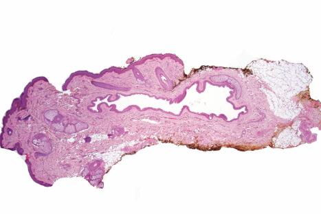 Fig. 32.19, Steatocystoma multiplex: this low-power view shows a collapsed empty cyst lined by squamous epithelium.