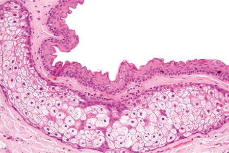 Fig. 32.20, Steatocystoma multiplex: the presence of sebaceous glands within the cyst wall is a characteristic feature.
