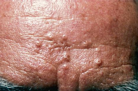 Fig. 32.2, Sebaceous hyperplasia: in this example, a group of papules is present on the forehead, a characteristic site.