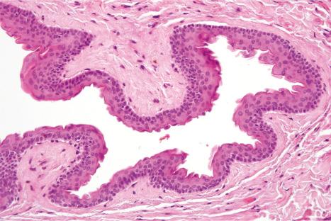 Fig. 32.21, Steatocystoma multiplex: a thick, wavy refractile hyaline cuticle covers the surface of the epithelium.