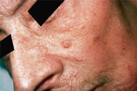 Fig. 32.22, Sebaceous adenoma: note the yellow papule on the cheek of this elderly patient.