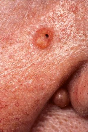 Fig. 32.23, Sebaceous adenoma: this example is dome-shaped and has a slightly scaly surface.