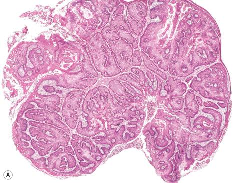 Fig. 32.24, Sebaceous adenoma: ( A ) this example has been shelled out. Note the circumscribed border; ( B ) there is a peripheral layer of basophilic germinative cells and inner sebaceous cells with bubbly cytoplasm and crenated nuclei.