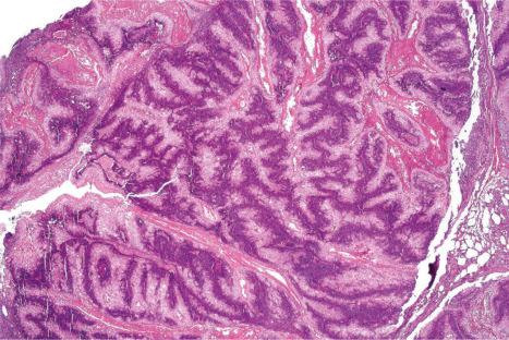 Fig. 32.25, Sebaceous adenoma: part of an ulcerated giant variant.