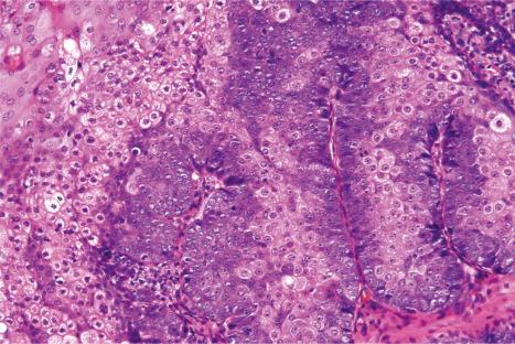 Fig. 32.26, Sebaceous adenoma: higher-power view showing retention of the architecture with peripheral basaloid cells and inner sebocytes. Note the mitotic figures.