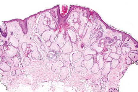 Fig. 32.3, Sebaceous hyperplasia: scanning view showing sebaceous glands grouped around a cystic infundibulum.