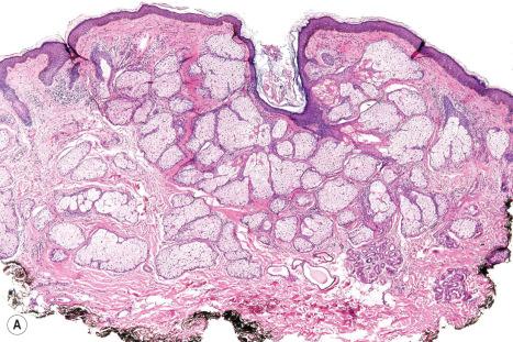 Fig. 32.4, ( A , B ) Sebaceous hyperplasia: the sebaceous lobules drain through short ductules into the central duct.