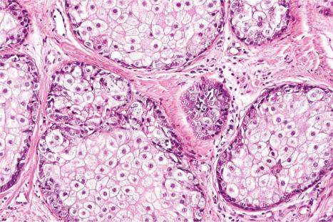 Fig. 32.5, Sebaceous hyperplasia: the hyperplastic sebaceous lobules mirror the normal sebaceous gland and consist of an outer layer of basaloid cells surrounding mature sebaceous cells with eosinophilic bubbly cytoplasm.