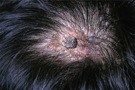 Fig. 32.7, Nevus sebaceous: in this example, basal cell carcinoma has developed in a nevus sebaceous.