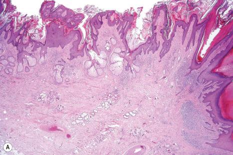 Fig. 32.8, Nevus sebaceous: ( A ) there is marked papillomatosis with hyperkeratosis. Note the almost complete absence of hair follicles. Apocrine glands are present in the center of the field; ( B ) high-power view showing apocrine glands.