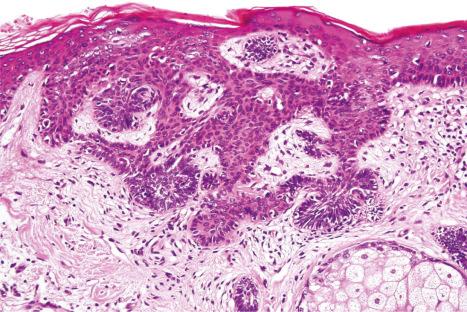 Fig. 32.9, Nevus sebaceous: several primitive hair germlike proliferations arising from the epidermis are seen in this field. Note the peripheral palisading.
