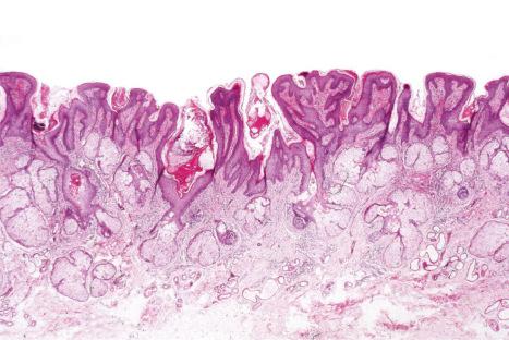 Fig. 32.10, Nevus sebaceous: in this example, there are excessive numbers of sebaceous glands. Note the absence of hair follicles.