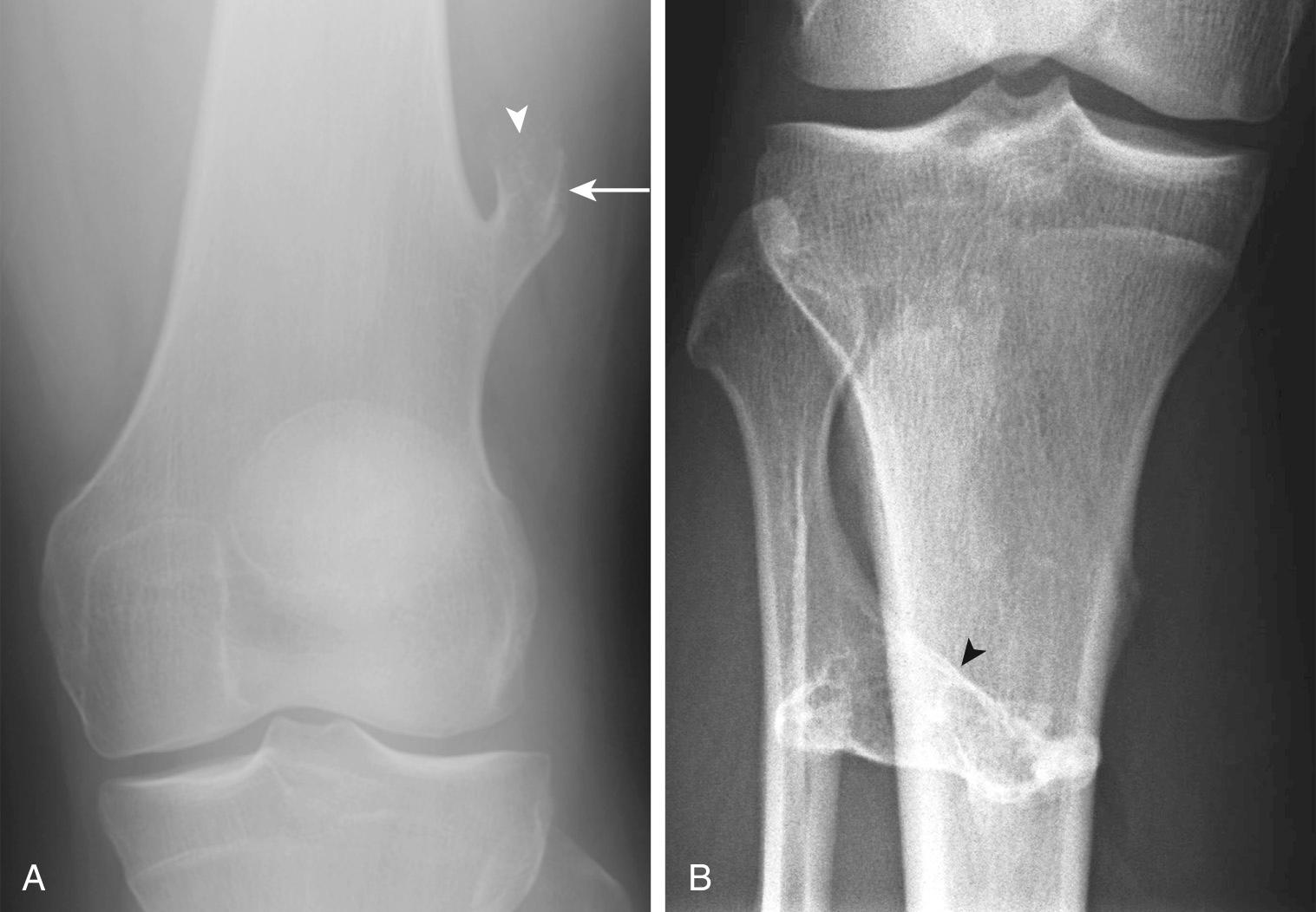 FIG 14.1, Osteochondroma