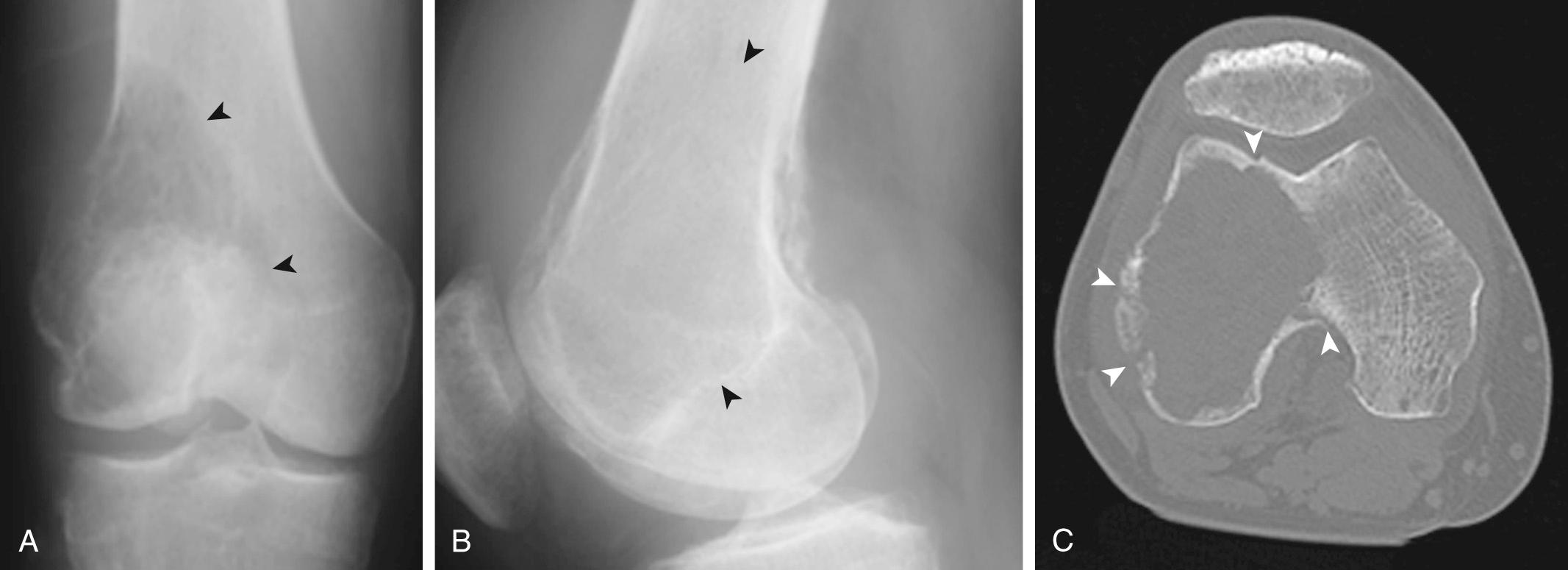 FIG 14.11, Forty-Three-Year-Old Man With Giant Cell Tumor of the Right Knee