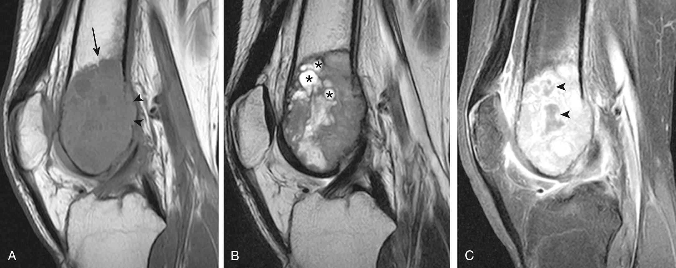 FIG 14.12, Twenty-Year-Old Man With Giant Cell Tumor and Secondary Aneurysmal Bone Cyst Formation