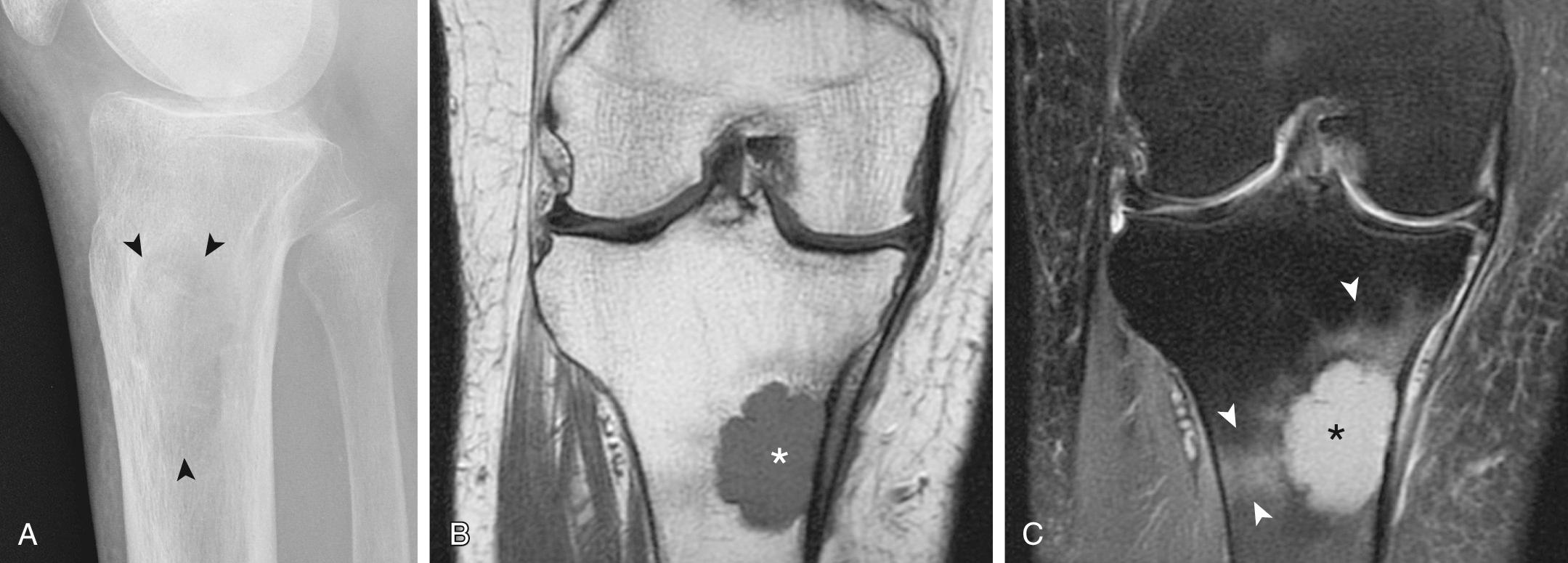 FIG 14.13, Seventy-Four-Year-Old Woman With Myeloma of the Proximal Tibia