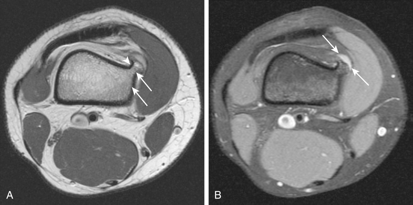 FIG 14.2, Thirteen-Year-Old Girl With Osteochondroma