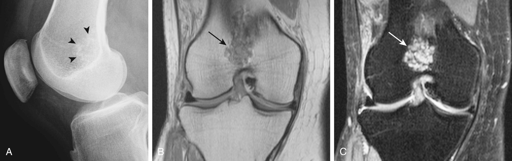 FIG 14.3, Distal Femoral Enchondroma in a 52-Year-Old Woman