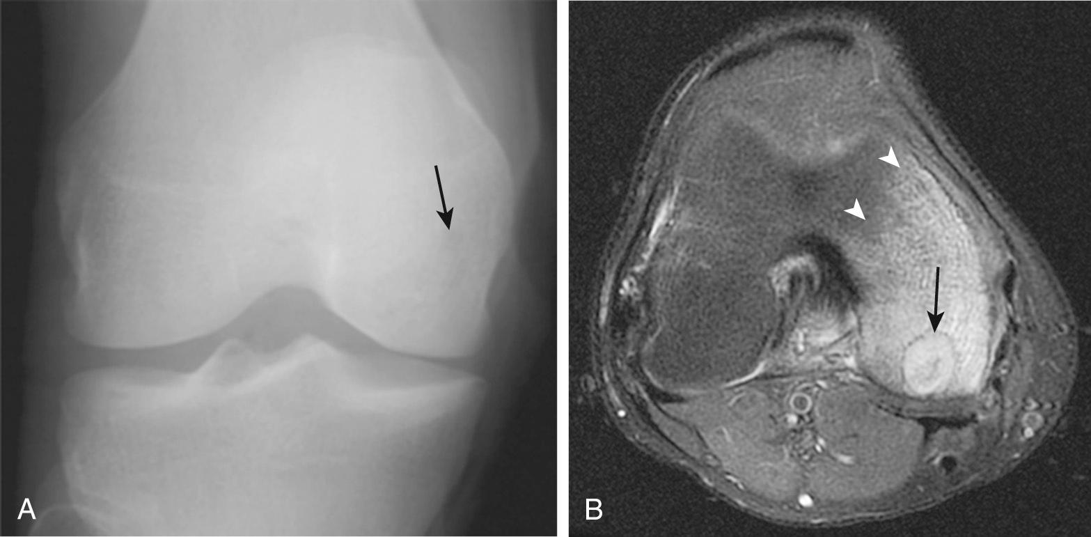 FIG 14.5, Chondroblastoma of the Distal Femur