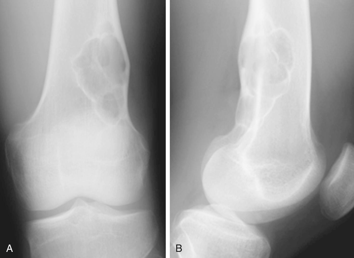 FIG 14.6, Nineteen-Year-Old Man With Nonossifying Fibroma