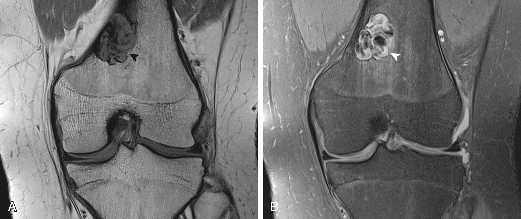 FIG 14.7, Nonossifying Fibroma in the Left Distal Femur