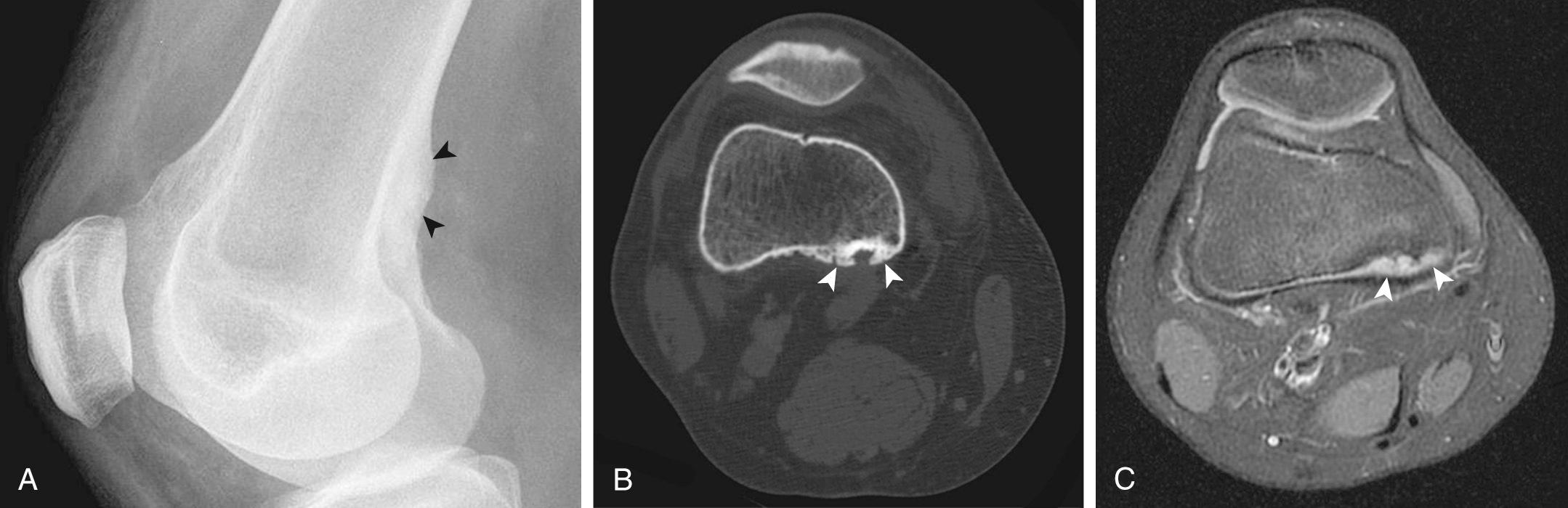 FIG 14.8, Cortical Desmoid of the Right Knee