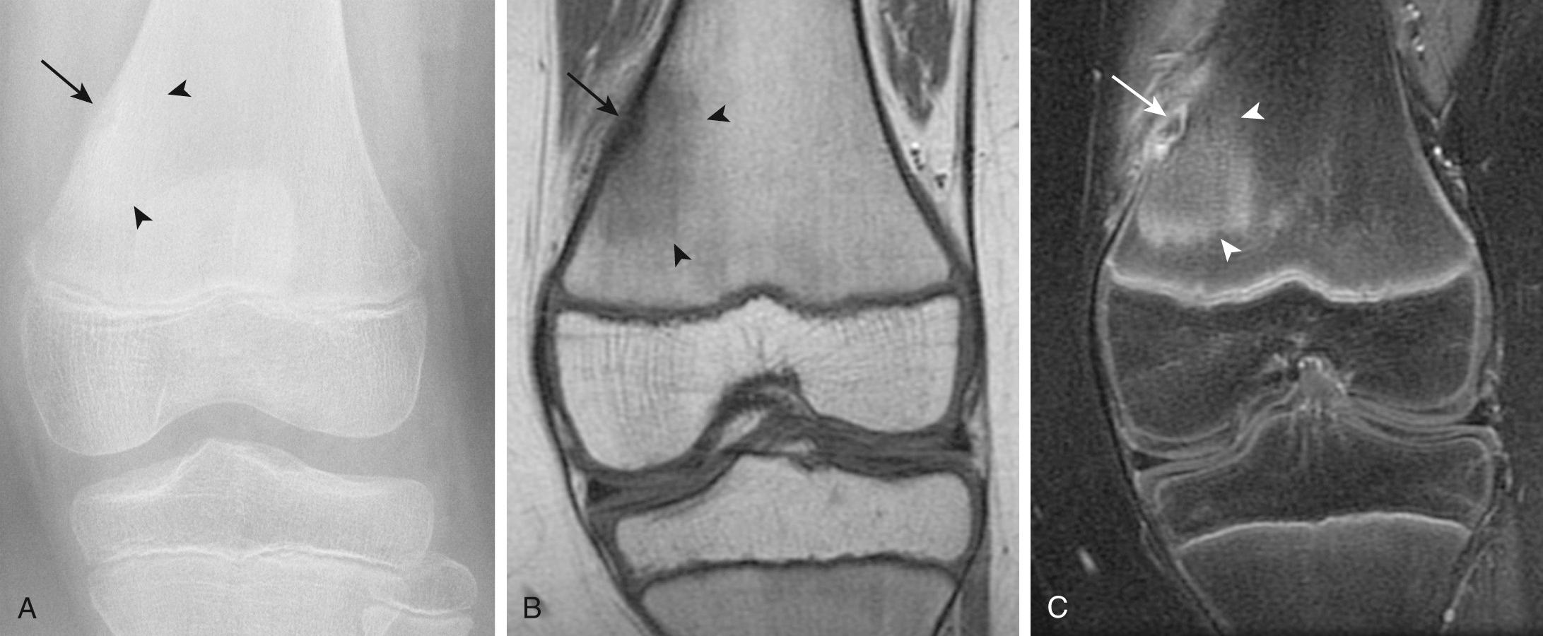 FIG 14.9, Ten-Year-Old Boy With Osteoid Osteoma of the Left Knee