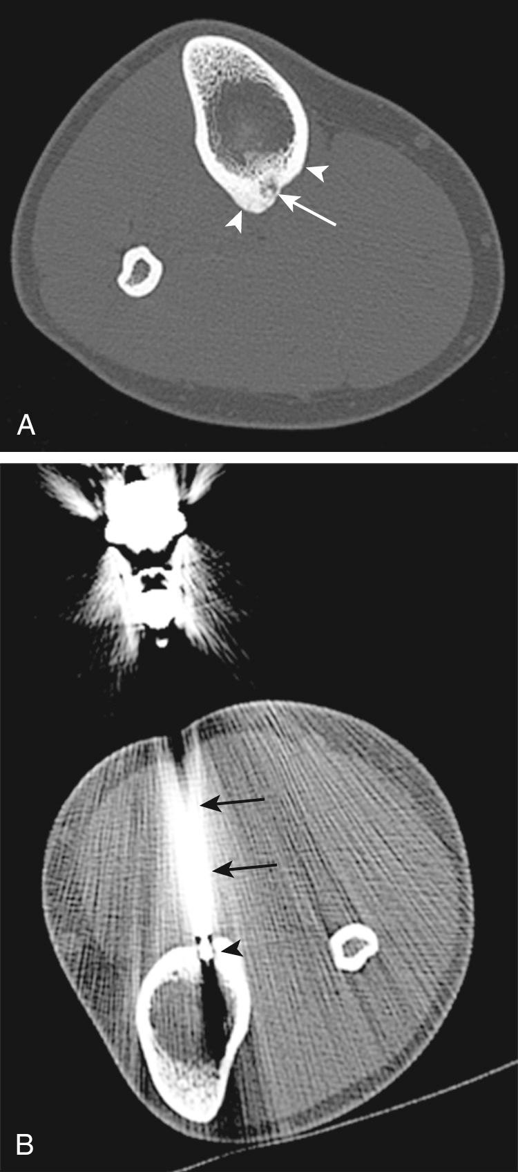 FIG 14.10, Fourteen-Year-Old Girl With Osteoid Osteoma