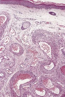 FIG. 3.14, Arteriovenous hemangioma. Superficial examples are often known as cirsoid aneurysm.