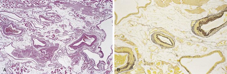 FIG. 3.15, Arteriovenous hemangioma. This deep lesion is composed of large vessels (A) that are distinguishable by the distribution of their elastic laminae (B). (Elastic van Gieson.)