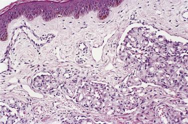 FIG. 3.3, Glomeruloid hemangioma. Capillary lobules protrude into preexisting vessels. Note the eosinophilic droplets.