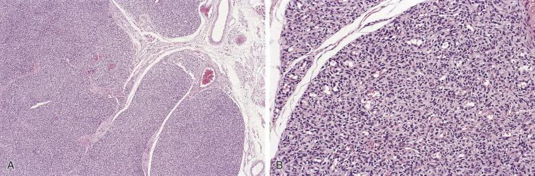 FIG. 3.5, Juvenille capillary hemangioma (infantile hemangioendothelioma). Note the lobular growth pattern (A) and closely packed, largely uncanalized capillaries (B).