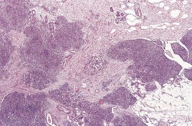 FIG. 3.7, Tufted angioma. Note the irregular distribution of capillary lobules and semilunar vascular spaces at their periphery (top right) .